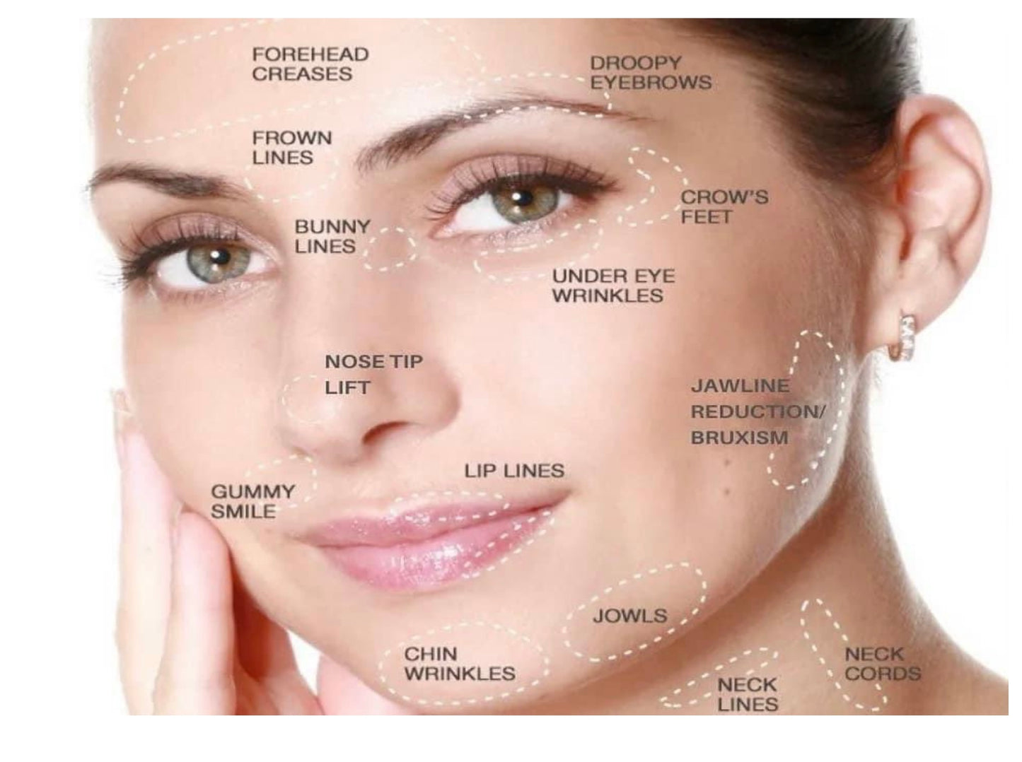 FREE DOCUMENT -BOTOX GUIDE-Injection points and unit conversions. PDF