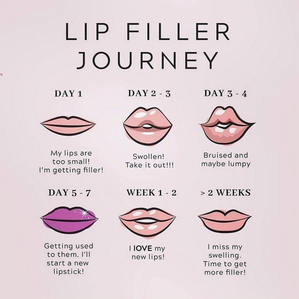 FREE DOCUMENT.LIP FILLER JOURNEY POSTER. EDIT THEM ACCORDINGLY